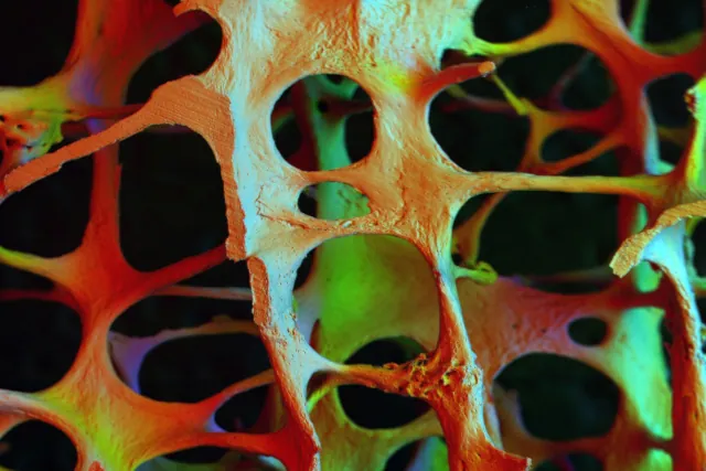 Osteoporose: Knochentrabekel im Elektronenmikroskop